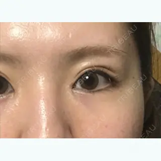 53日目の経過画像（1枚目）