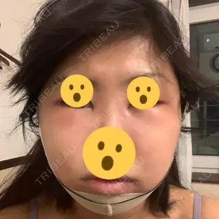 2日目の経過画像（1枚目）