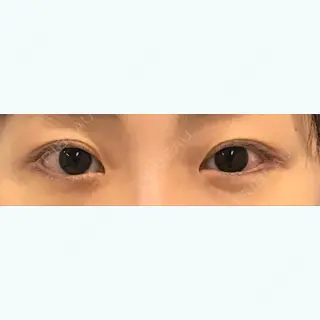 0日目の経過画像（1枚目）