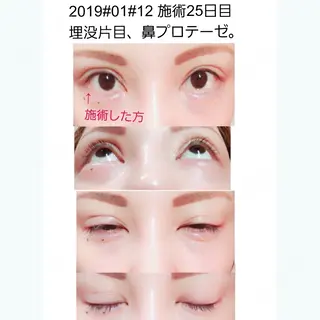25日目の経過画像（1枚目）