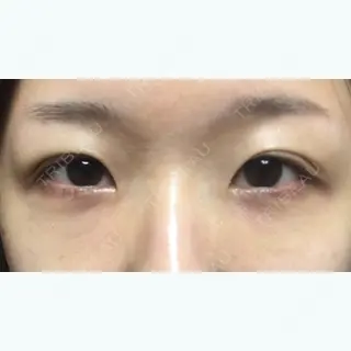 11日目の経過画像（1枚目）