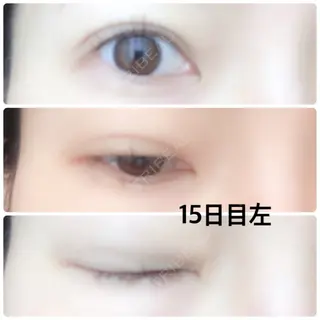 15日目の経過画像（2枚目）