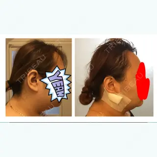 0日目の経過画像（2枚目）