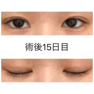 14日目の経過画像（1枚目）