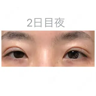 2日目の経過画像（1枚目）