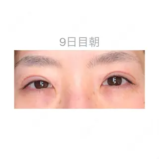 9日目の経過画像（1枚目）