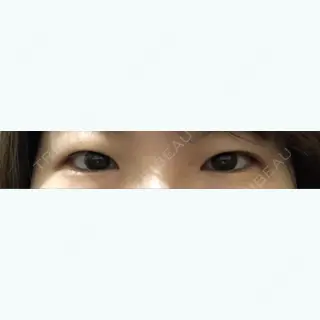 42日目の経過画像（1枚目）