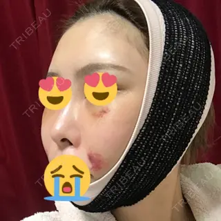 13日目の経過画像（3枚目）