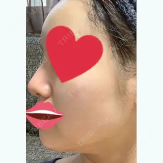 2日目の経過画像（3枚目）