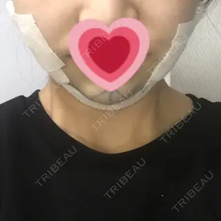 0日目の経過画像（1枚目）