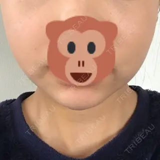 3日目の経過画像（1枚目）