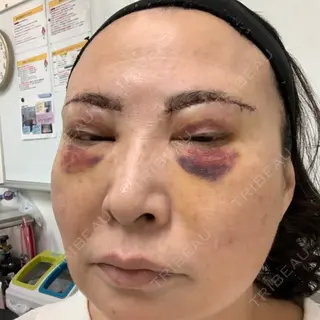 0日目の経過画像（3枚目）