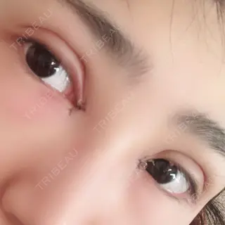 2日目の経過画像（3枚目）