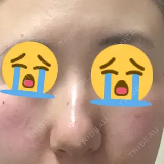 9日目の経過画像（1枚目）