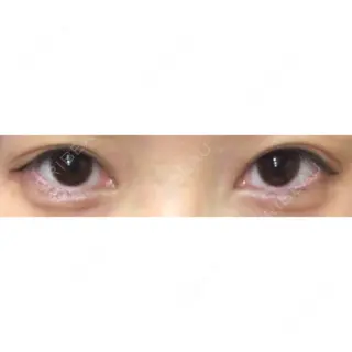 5日目の経過画像（1枚目）