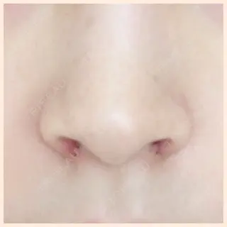 5日目の経過画像（1枚目）