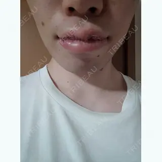 2日目の経過画像（3枚目）