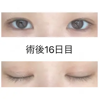 15日目の経過画像（1枚目）