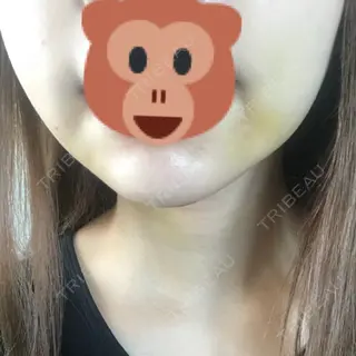 4日目の経過画像（2枚目）