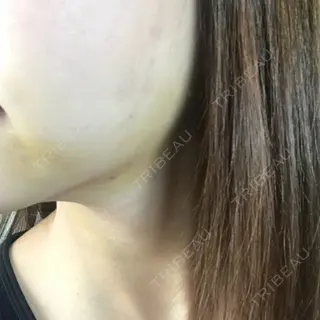 4日目の経過画像（3枚目）