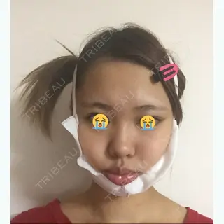 0日目の経過画像（1枚目）
