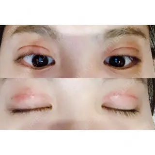 6日目の経過画像（2枚目）