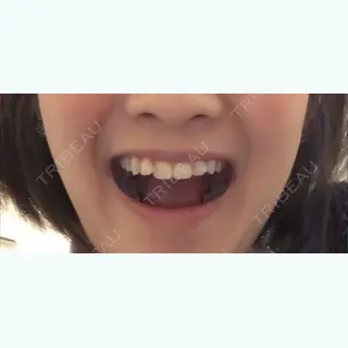 26日目の経過画像（2枚目）
