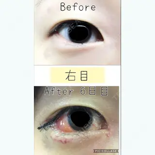 6日目の経過画像（2枚目）