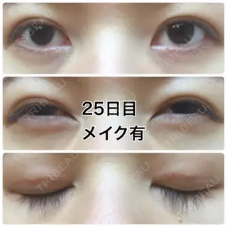 25日目の経過画像（1枚目）