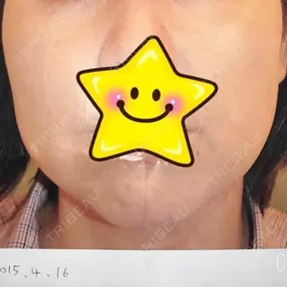 51日目の経過画像（1枚目）