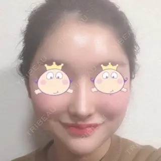 5日目の経過画像（3枚目）