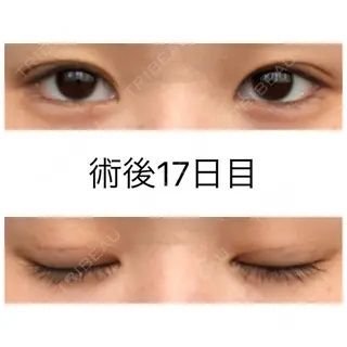 16日目の経過画像（1枚目）