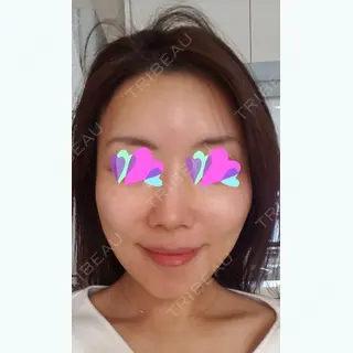 5日目の経過画像（1枚目）