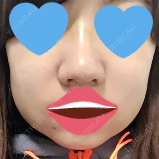 5日目の経過画像（3枚目）