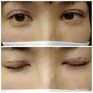 0日目の経過画像（3枚目）