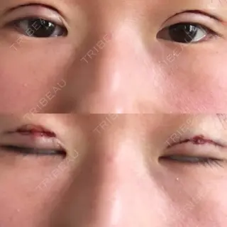 0日目の経過画像（1枚目）