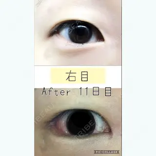 11日目の経過画像（2枚目）