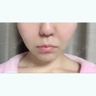 28日目の経過画像（1枚目）