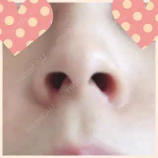 13日目の経過画像（1枚目）
