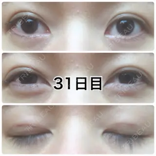 31日目の経過画像（1枚目）
