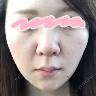 9日目の経過画像（1枚目）