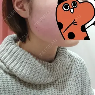 0日目の経過画像（3枚目）