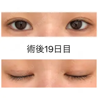 18日目の経過画像（1枚目）