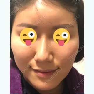 7日目の経過画像（1枚目）