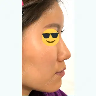 7日目の経過画像（3枚目）