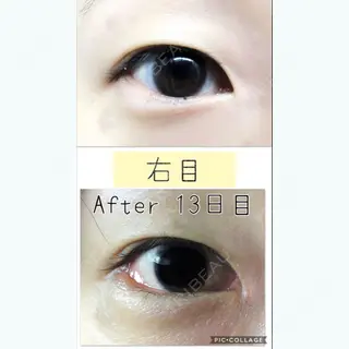 13日目の経過画像（2枚目）