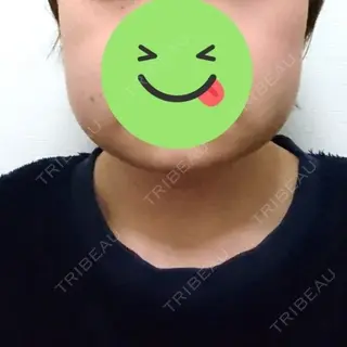 3日目の経過画像（1枚目）