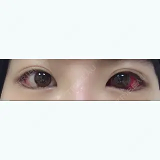 0日目の経過画像（1枚目）
