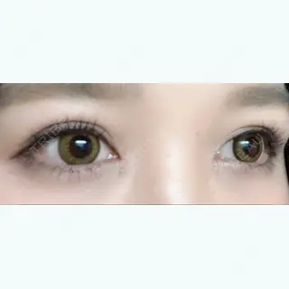 20日目の経過画像（3枚目）