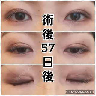 57日目の経過画像（1枚目）